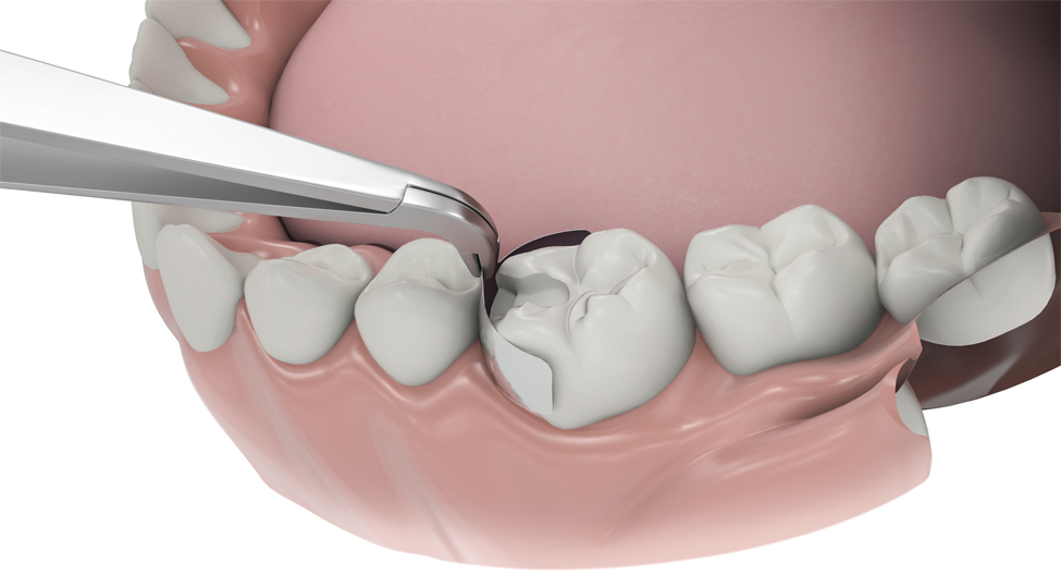 Garrison Dental  Composi-Tight® 3D Fusion™