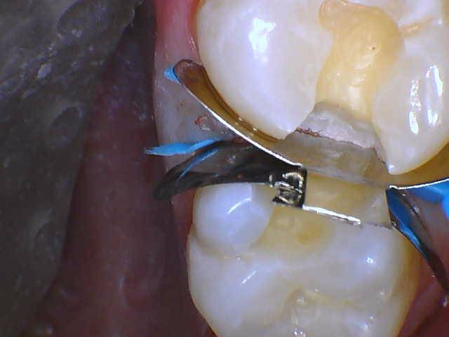 Quad Matrix System Teeth 2 and 3 B2B Class II Restoration Band and Wedge 2