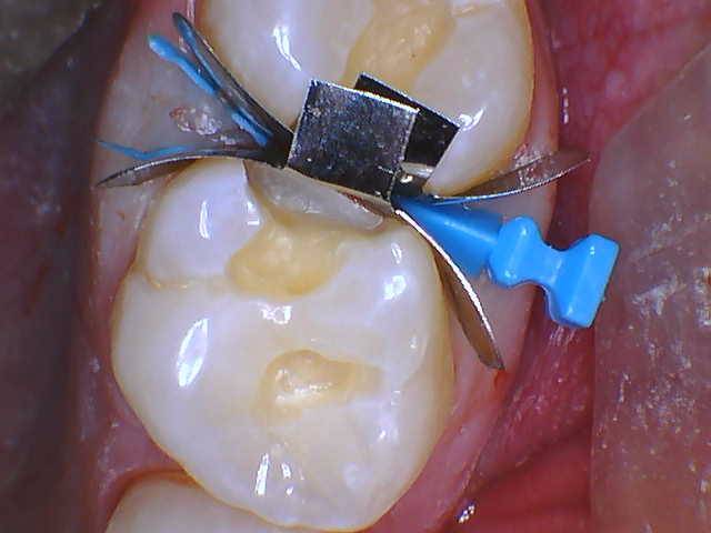 Quad Matrix System Teeth 2 and 3 B2B Class II Restoration Band and Wedge 3