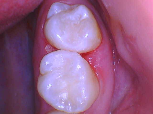 Quad Matrix System Teeth 2 and 3 B2B Class II Restoration Finished 2 and 3