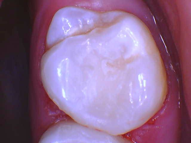 Quad Matrix System Teeth 2 and 3 B2B Class II Restoration Finished 2