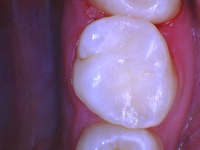 Quad Matrix System Teeth 2 and 3 B2B Class II Restoration Finished 3