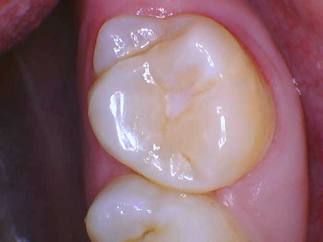 Quad Matrix System Teeth 2 and 3 B2B Class II Restoration Pre Op 2 Photo