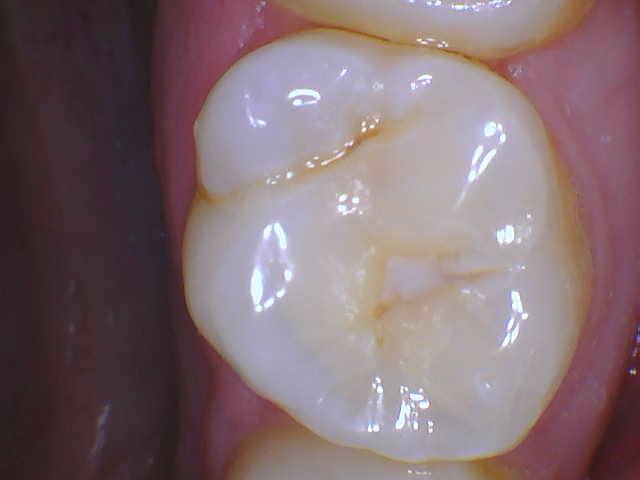 Quad Matrix System Teeth 2 and 3 B2B Class II Restoration Pre Op 3 Photo