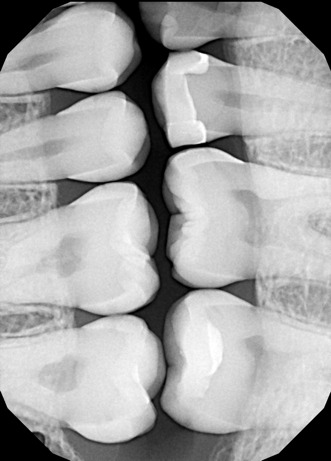 Quad Matrix System Teeth 2 and 3 B2B Class II Restoration Pre Op Radiograph