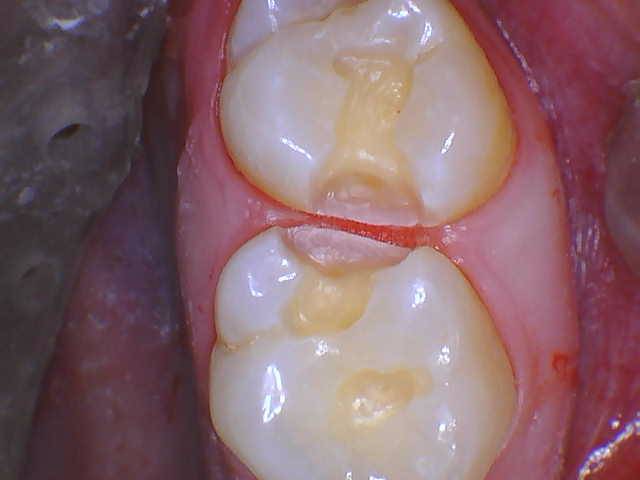 Quad Matrix System Teeth 2 and 3 B2B Class II Restoration Prepped 2 and 3 Photo