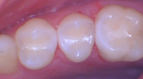  Quad Matrix System Back to Back Restoration by Dr. Burton - 1.png 