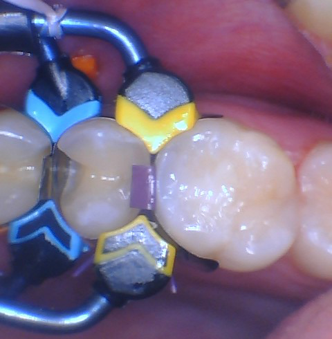  Quad Matrix System Back to Back Restoration by Dr. Burton - 10.png 