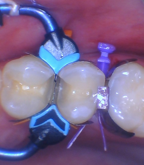  Quad Matrix System Back to Back Restoration by Dr. Burton - 11.png 