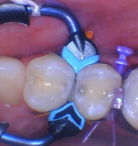  Quad Matrix System Back to Back Restoration by Dr. Burton - 12.png 