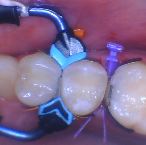  Quad Matrix System Back to Back Restoration by Dr. Burton - 13.png 