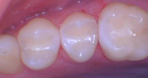  Quad Matrix System Back to Back Restoration by Dr. Burton - 14.png 