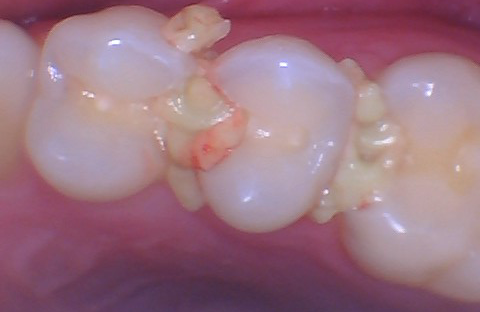  Quad Matrix System Back to Back Restoration by Dr. Burton - 4.png 