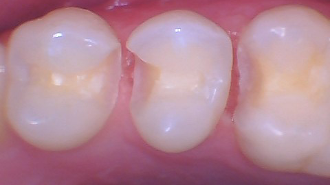  Quad Matrix System Back to Back Restoration by Dr. Burton - 5.png 