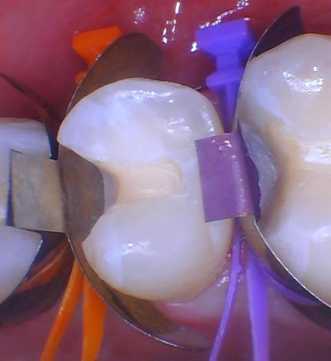  Quad Matrix System Back to Back Restoration by Dr. Burton - 7.png 