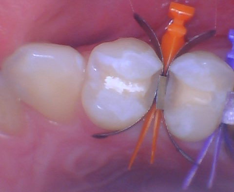  Quad Matrix System Back to Back Restoration by Dr. Burton - 8.png 