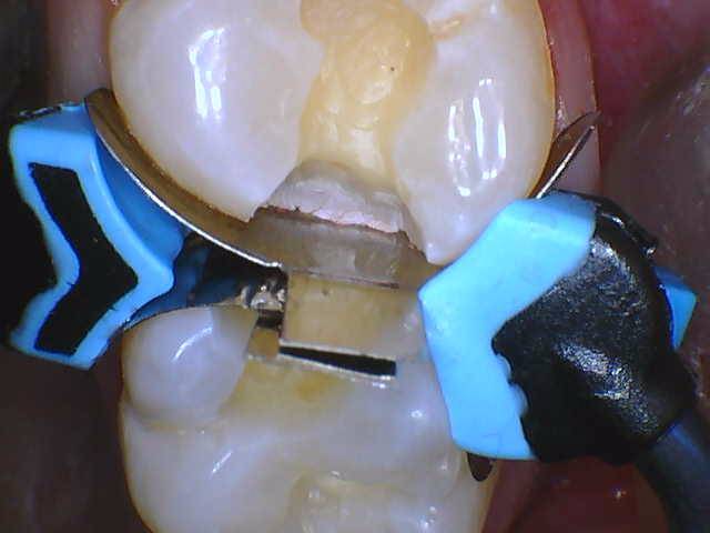 Quad Matrix System Teeth 2 and 3 B2B Class II Restoration Ring on 2