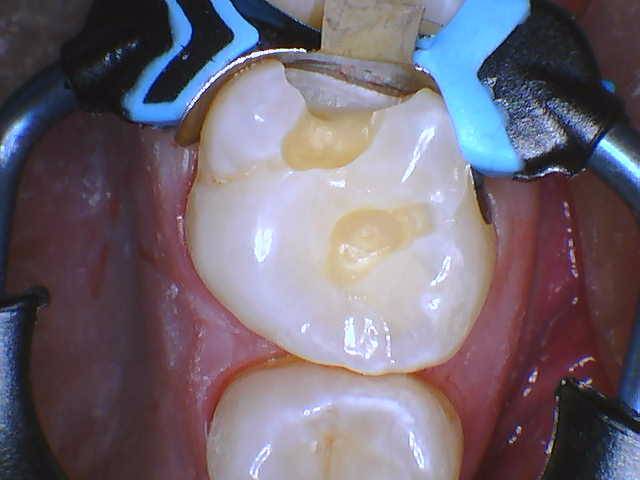 Quad Matrix System Teeth 2 and 3 B2B Class II Restoration Ring on 3