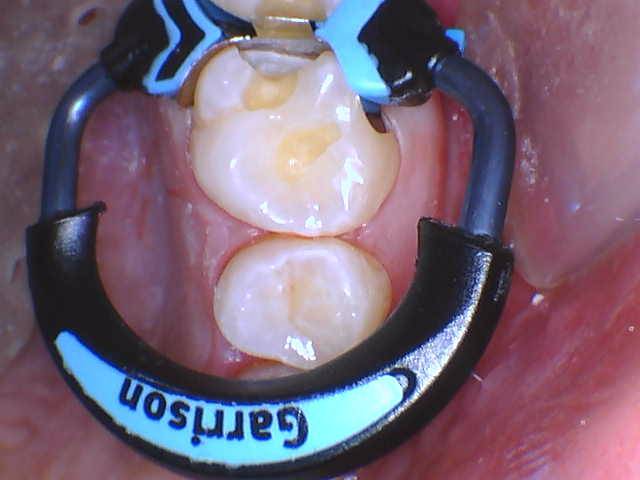 Quad Matrix System Teeth 2 and 3 B2B Class II Restoration Ring on 3