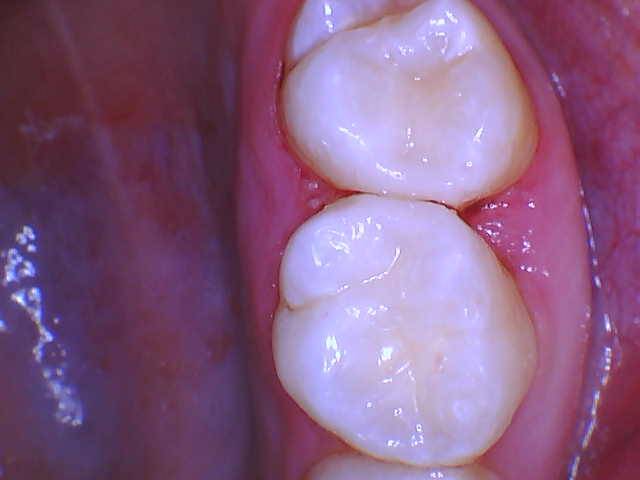 Quad Matrix System Teeth 2 and 3 B2B Class II Restoration Untrimmed 2 and 3