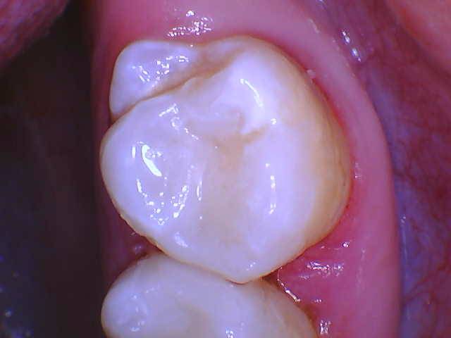 Quad Matrix System Teeth 2 and 3 B2B Class II Restoration Untrimmed 2