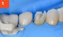 Composi-Tight 3D Fusion Tooth Before