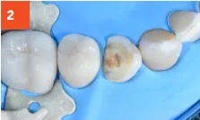 Composi-Tight 3D Fusion Tooth Filling