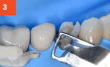 Composi-Tight 3D Fusion Tooth Filling