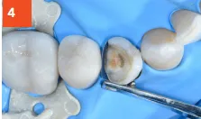 Composi-Tight 3D Fusion Tooth Filling