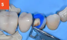 Composi-Tight 3D Fusion Tooth Filling