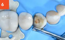 Composi-Tight 3D Fusion Matrix Tooth Before