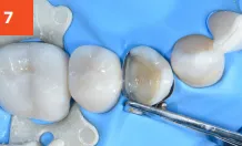 Composi-Tight 3D Fusion Before Tooth