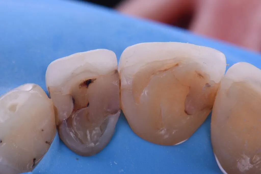 Fusion Teeth Before