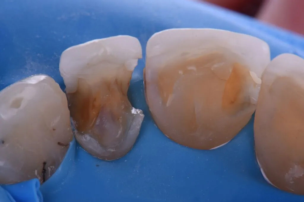 Fusion teeth before