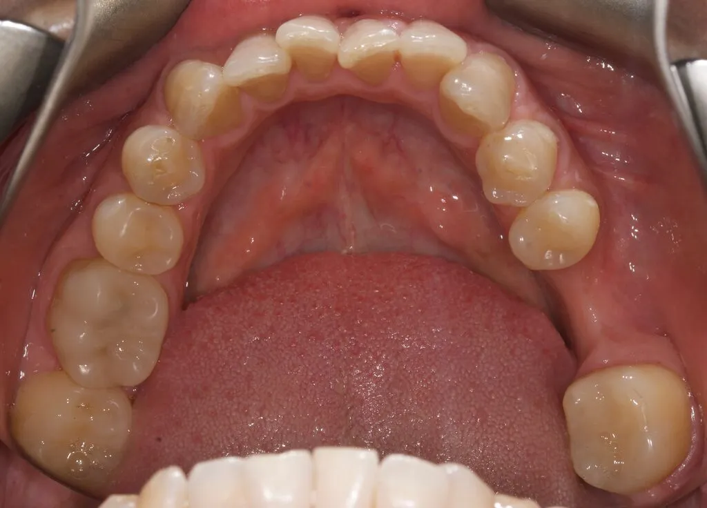 Teeth before FitStrip System