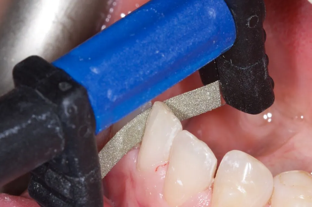 FitStrip IPR in between two teeth