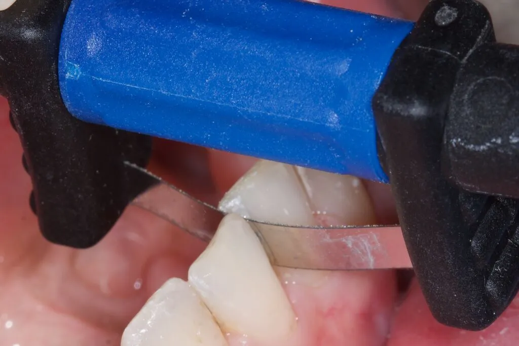 FitStrip IPR in between two teeth