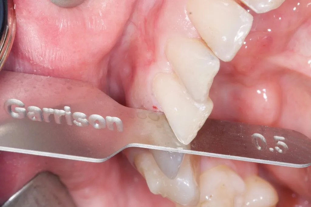 FitStrip IPR Key in between teeth