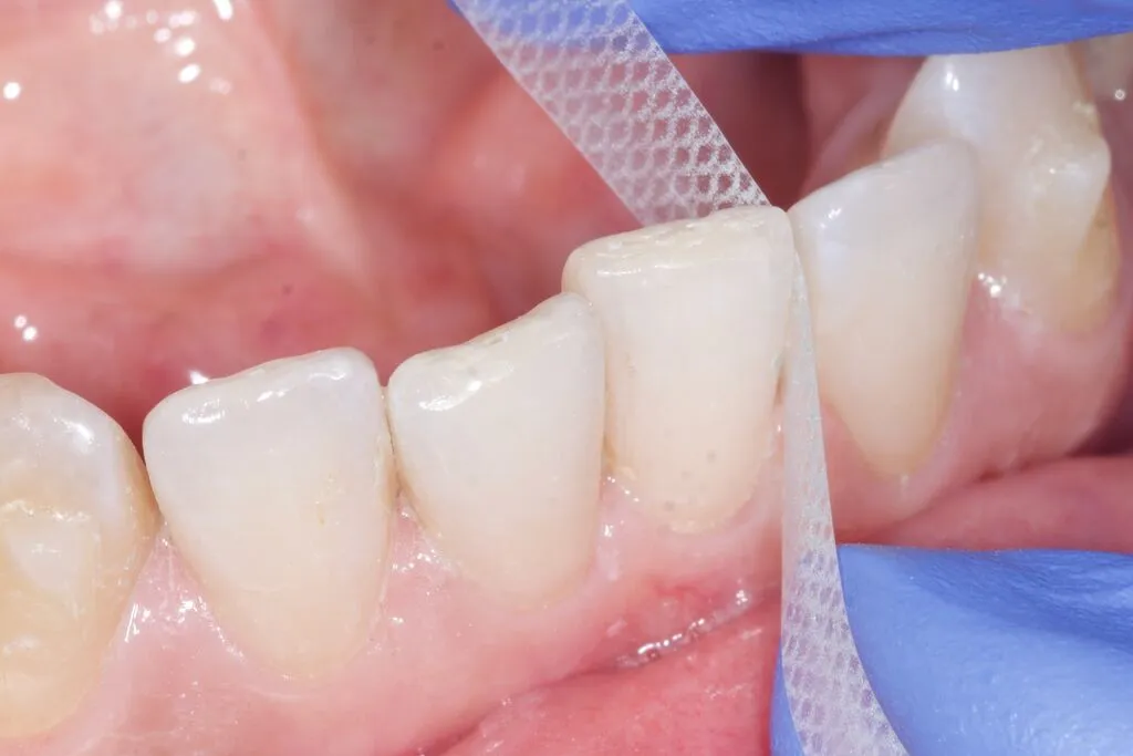 Polishing teeth post FitStrip use