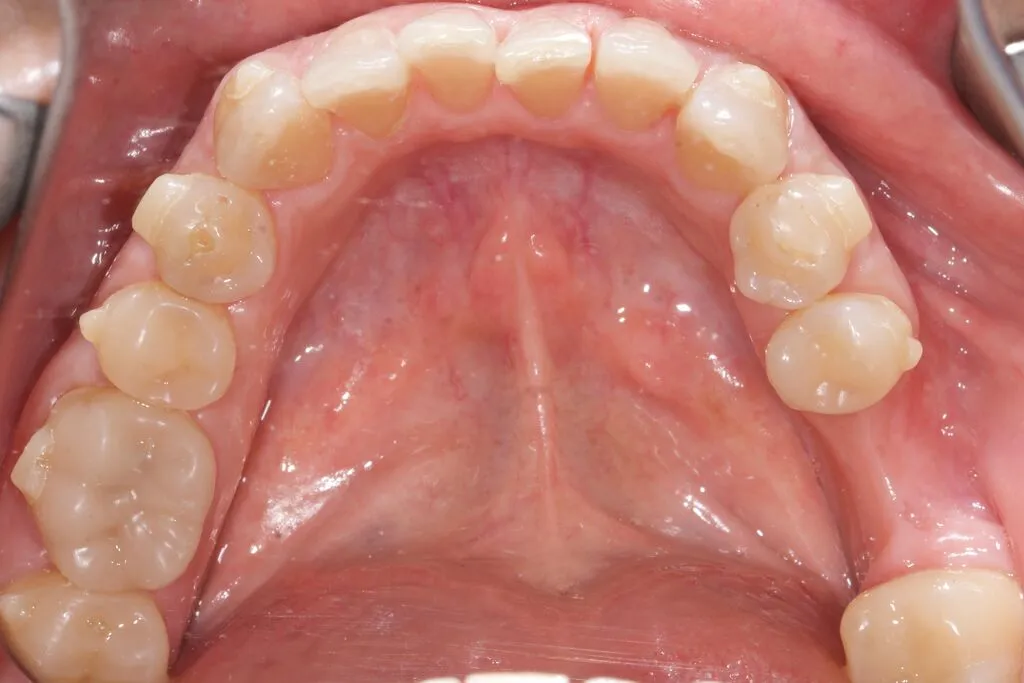 FitStrip final teeth results