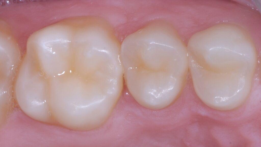 Strata-G Matrix Teeth Before