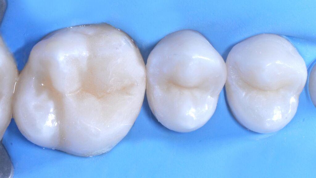 Strata-G Matrix System Teeth Final