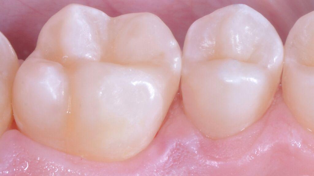 Strata-G Matrix System Teeth Final