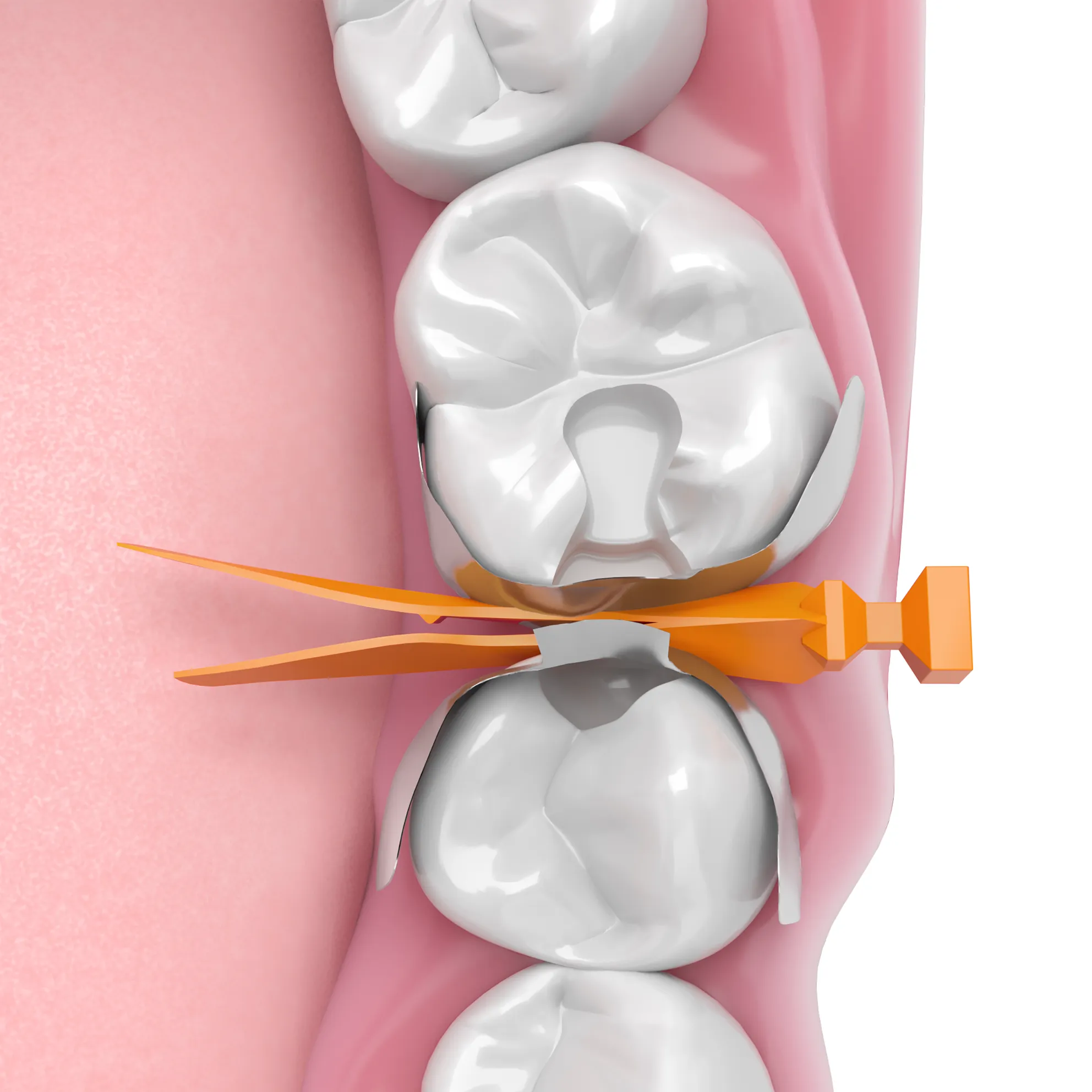 BTB_Wedge_final Quad Wedge